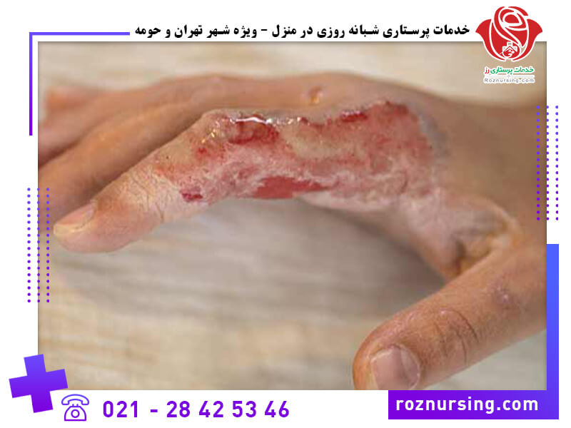 درمان زخم-204